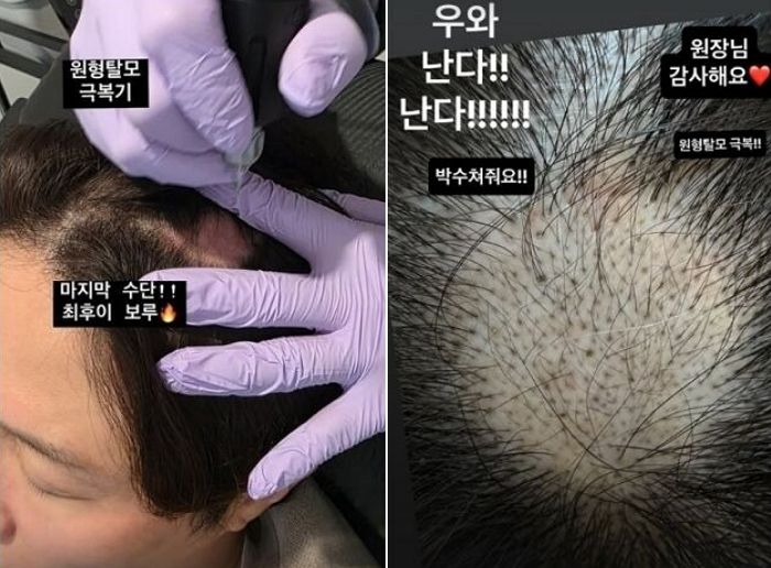 ‘이솔이♥’ 박성광, 대박 소식 전했다... 시술 2주 만에 ‘원형탈모’ 극복