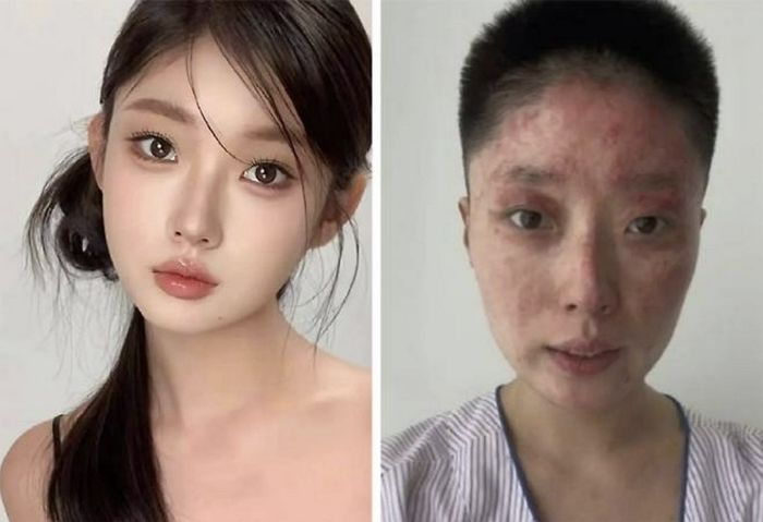 담배 피우려던 아빠 때문에 집 폭발... 얼굴에 심각한 화상 입은 뷰티 인플루언서