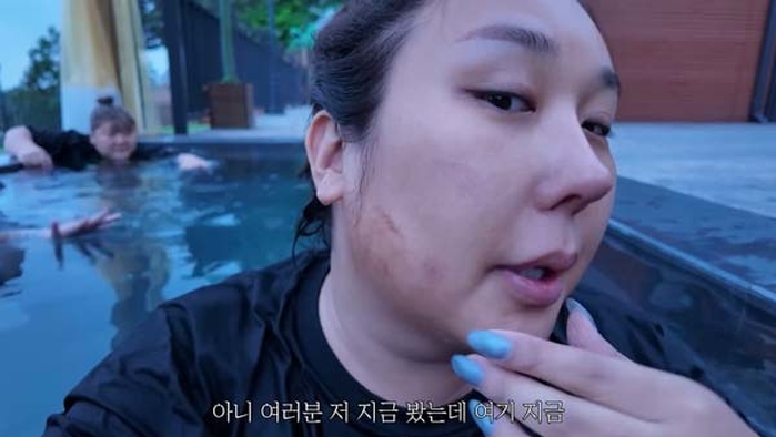 얼굴에 멍 한가득 생긴 풍자 “이중 턱 없애는 시술 받은 탓”