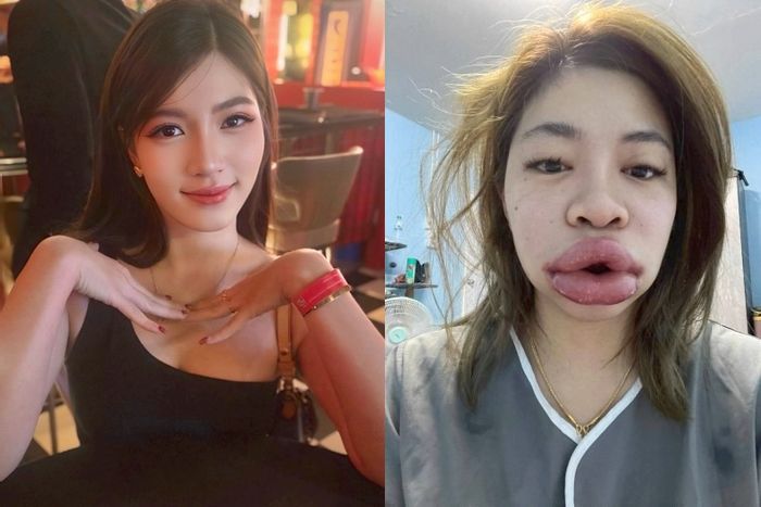 “입술 필러 욕심내다가... 예쁜 얼굴 ‘모다피’로 변해 버렸습니다”