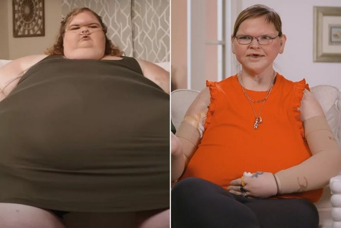 223kg 뺀 뒤 치즈처럼 늘어진 피부... ‘피부 제거 수술’로 말끔히 없앤 여성의 놀라운 변화 (영상)