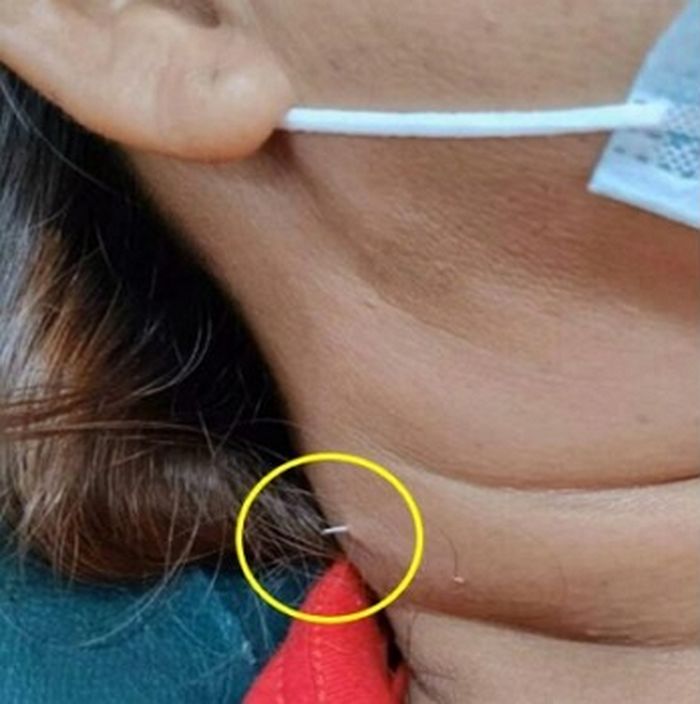 “2주 전 밥 먹다 삼킨 2cm ‘생선 가시’가 목 피부를 뚫고 나왔습니다”