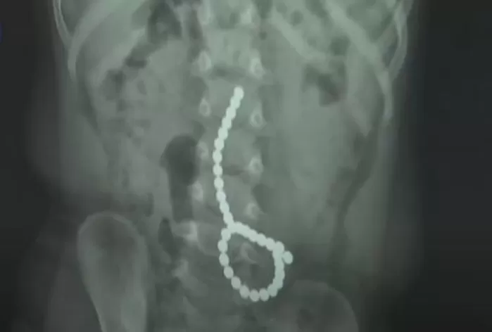 23개월 아이가 장난감 자석 33개를 삼켜 대학병원에서 긴급수술을 받는 일이 발생했다. 사진은 A군의 X-ray 촬영 결과. [사진=KBS 보도화면 캡처]