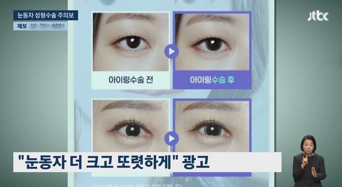 써클렌즈 안 껴도 크고 또렷하게... 요즘 유행 중인 ‘눈동자 수술’, 시력 잃을 수도