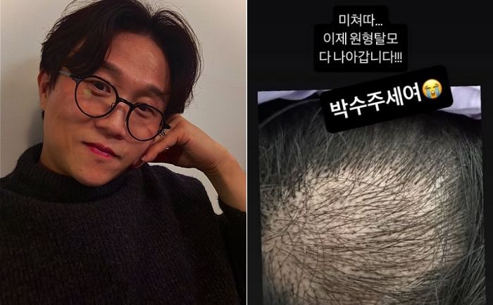 “여러분 박수 주세요!”... 박성광, 37일차 ‘탈모 치료’ 근황 공개했다