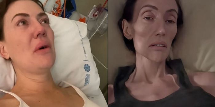 잦은 복통 무시했다가 ‘대장암 말기’ 시한부 진단받았던 30대 여성... 충격적인 변화