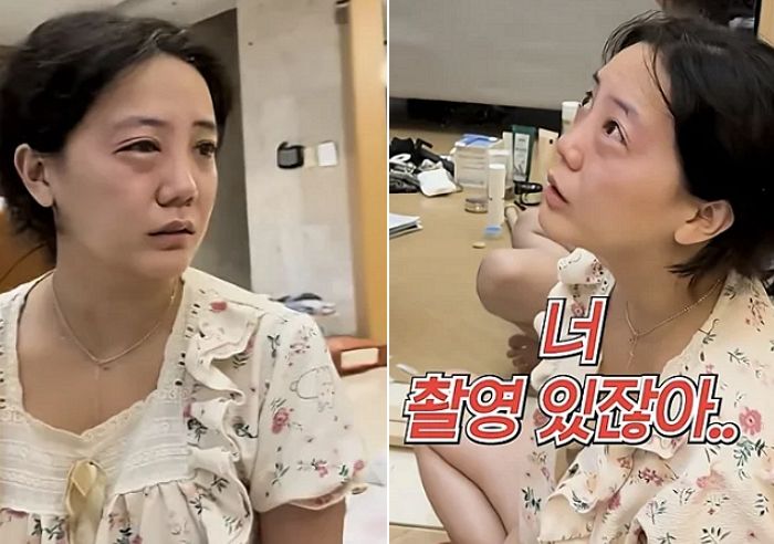 “안면 부상에 이어”... 촬영 앞두고 ‘알레르기 증상’ 때문에 눈 퉁퉁 부은 고은아