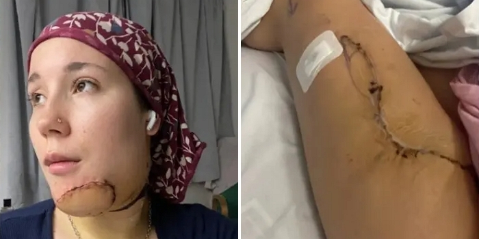 “턱에서 다리털 나더니 소름도 돋아”... 피부암 제거한 여성이 겪고 있는 충격적인 부작용