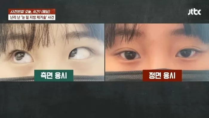 [뉴시스] A씨의 눈. (출처=JTBC 사건반장) *재판매 및 DB 금지