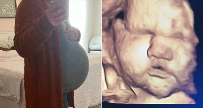 5㎏ 초우량아 ‘자연분만’으로 탄생... 산모는 ‘골반뼈 골절’로 6개월 치료