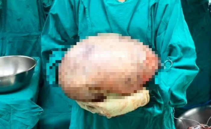 “맨날 먹어서 살찐 줄 알았는데... ” 배에 8㎏짜리 ‘이것’ 들어있었다