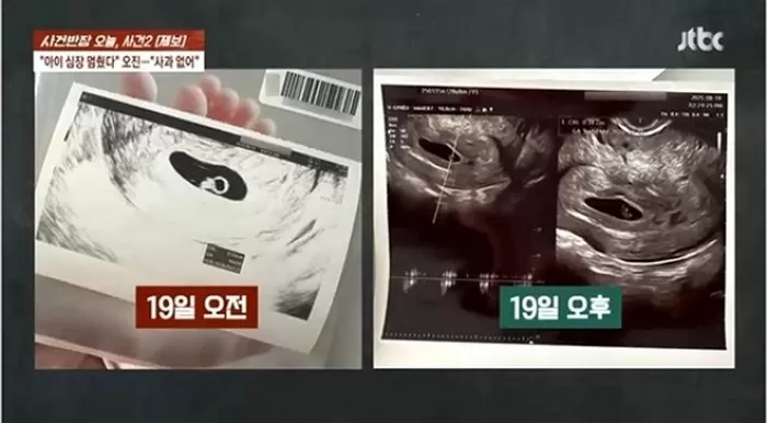 산부인과 의사가 태아 심장이 안 뛴다고 잘못 진단해 소송을 고민 중이라는 제보자 사연이 전해졌다. 사진은 제보자가 공유한 초음파 사진. /사진=JTBC 사건반장 캡처