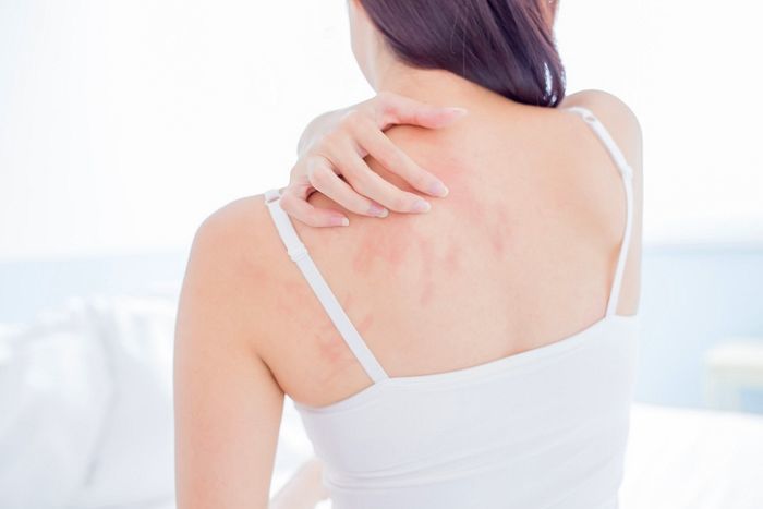 한랭과민증,콜린성 두드러기,아토피 증상,코로나 두드러기,코로나 백신 후유증