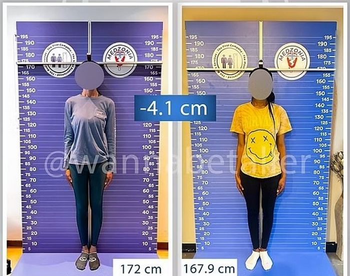 “남친 사귀려고”... 극심한 고통 꾹 참고 ‘키 축소 수술’ 받는 여성들