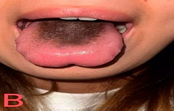 결핵 치료 중 ‘이 약’으로 혀가 까맣게 변한 여성... 무슨 일인지 봤더니