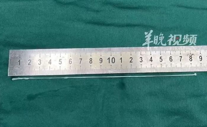 살아있는 뱀 쓸개 생식한 중국 男... 뇌에서 18cm 기생충 나왔다