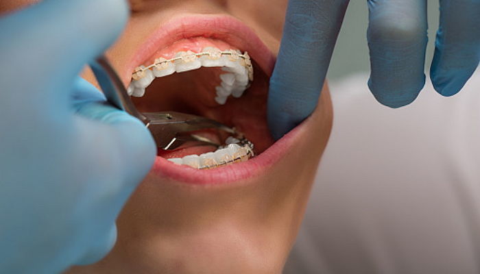 치아 교정기 해본 사람이라면 '백 번 공감'하는 고충 8가지