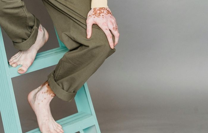 “가을볕 쬐니 흰 반점이”... 자외선에 오래 노출될수록 ‘이 병’ 위험 높인다