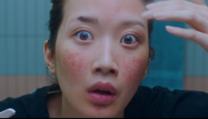 ‘여신에게도 콤플렉스’... 여드름인줄 알았던 내 피부, 알고 보니 주사?