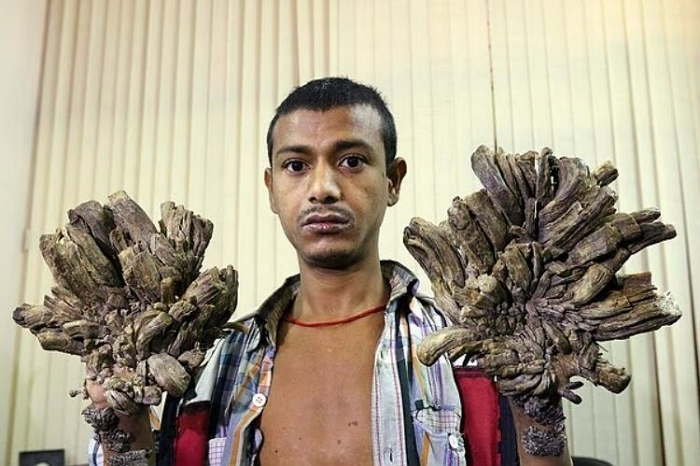 피부가 ‘나무’처럼 변하는 희귀병 앓는 남성... “10년 넘게 손 못 써”