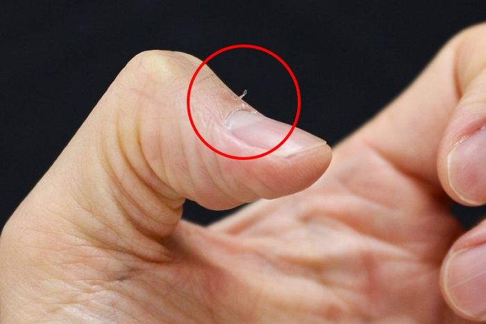 습관처럼 뜯는 거스러미, 심하면 손톱 빠질 수 있다... ‘조갑주위염’ 주의보