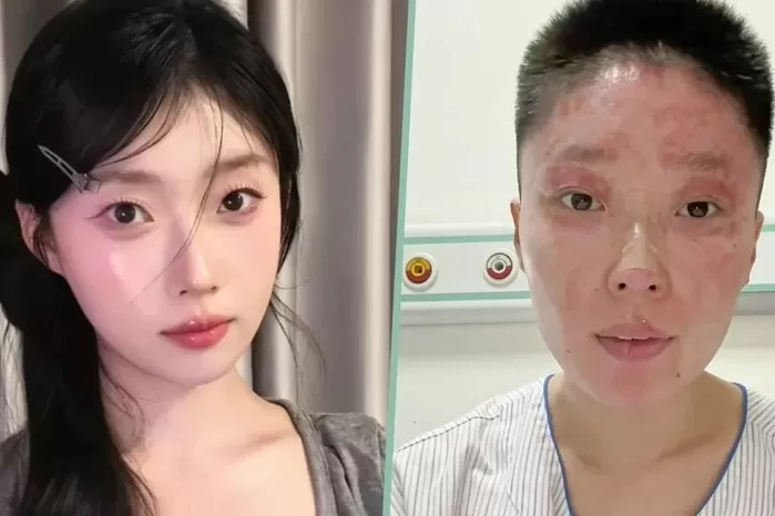 가스 폭발로 화상 입은 모델, 회복 과정 공유하며 인플루언서 활동 시작