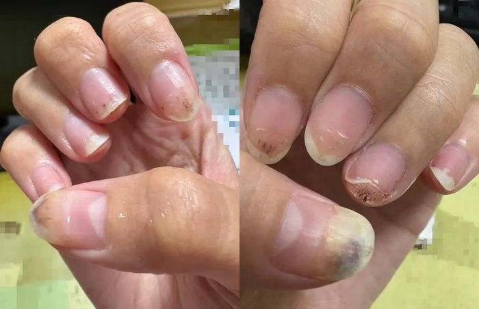 네일샵 실수로 손가락에서 피난 뒤 감염... “손톱 다 망가지고 통증에 시달리고 있습니다”