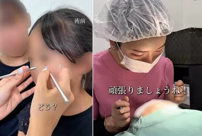 10세 아이 성형수술 홍보한 일본 병원, “예뻐지고 싶니?” 논란