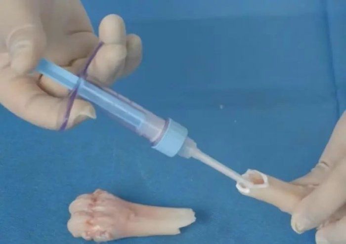 중국 연구진 “3분 만에 골절 치료할 수 있는 ‘뼈 접착제’ 개발했다”