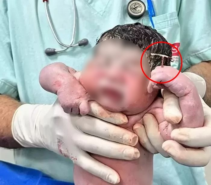 피임 확률 99% 뚫고 태어난 아이... 의사는 아기 손에 ‘피임장치’ 들렸다