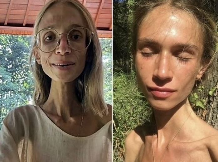 “과일만 먹었어요”... 몸무게 22㎏ 된 20대 여성, 결국 숨졌다