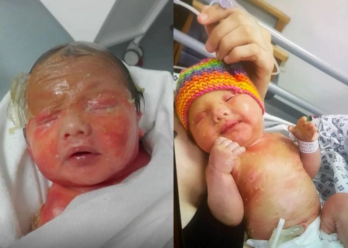 피부가 물고기 ‘비늘’처럼 갈라지는 희귀 유전질환 갖고 태어난 아기의 안타까운 근황