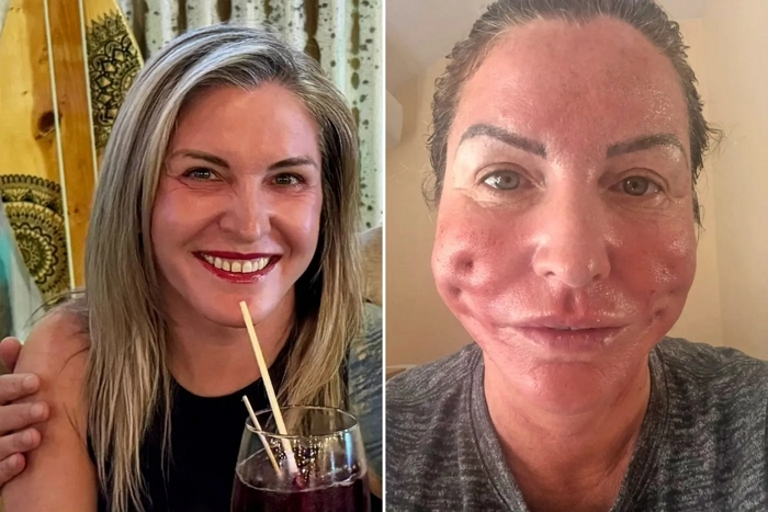 점심시간에 짬 내서 15분 걸리는 ‘실 리프팅’ 시술했다가 얼굴에 구멍 나버린 여성