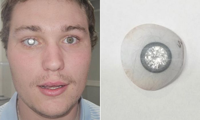 시력 잃은 후, ‘인공안구’ 넣으면서 2캐럿짜리 ‘다이아몬드’ 넣은 美 남성