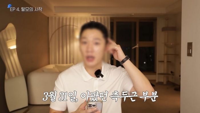얼굴 작아보이려다 머리 빠져... ‘귀 필러’ 후 탈모 부작용 고백한 남성 (영상)