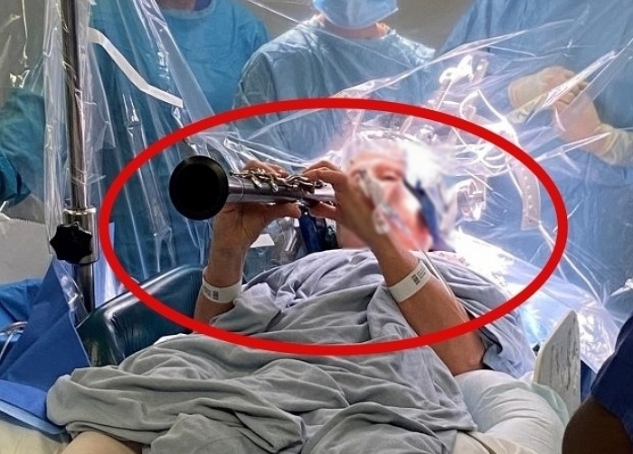 ‘뇌수술’ 도중 클라리넷 연주하는 환자?... 수술실에서 벌어진 연주회 (영상)