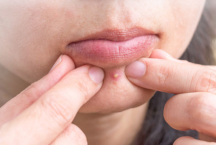 피부과 의사도 ‘강추’한 약국서 1만원대에 구매 가능한 ‘여드름 연고’ 3가지