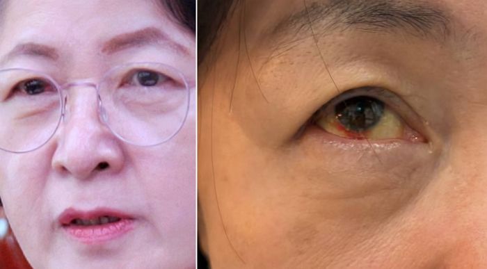 추미애, 실핏줄 터진 안구 사진 공개... “법사위 왼쪽 줄 고성에 귀까지 먹먹해”