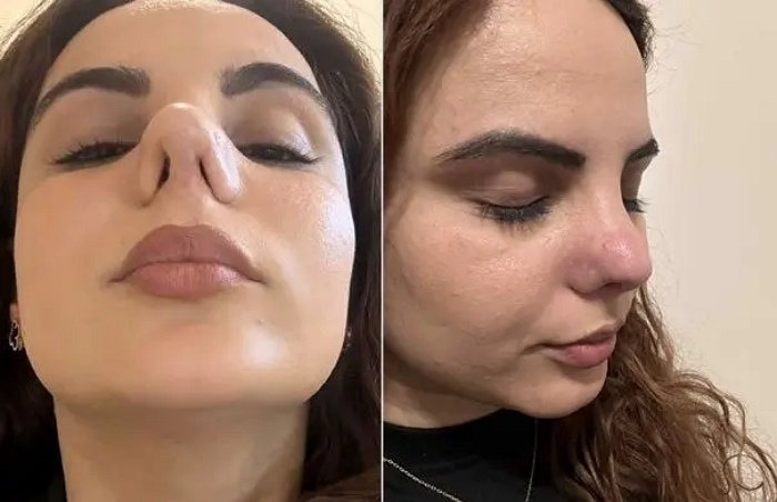 코수술 세 번이나 실패한 여성의 심각한 상태... “숨을 쉴 수 없는 상황”