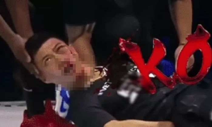 세계 ‘따귀 대회’ 나간 중국 2천년 전통 무술 전승자, 한 방에 광대뼈 골절 중상