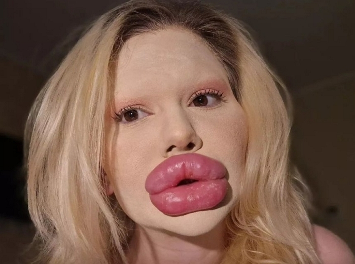 “더 이상 못해줘”... 입술 필러에 3800만원 쓴 여성, 극단적 ‘입술 필러’로 시술 거부당해