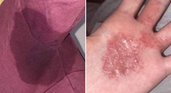 “하루 5번 샤워해도 멈추지 않았다”... 14세에 학교 그만둔 ‘다한증’ 여성의 사연