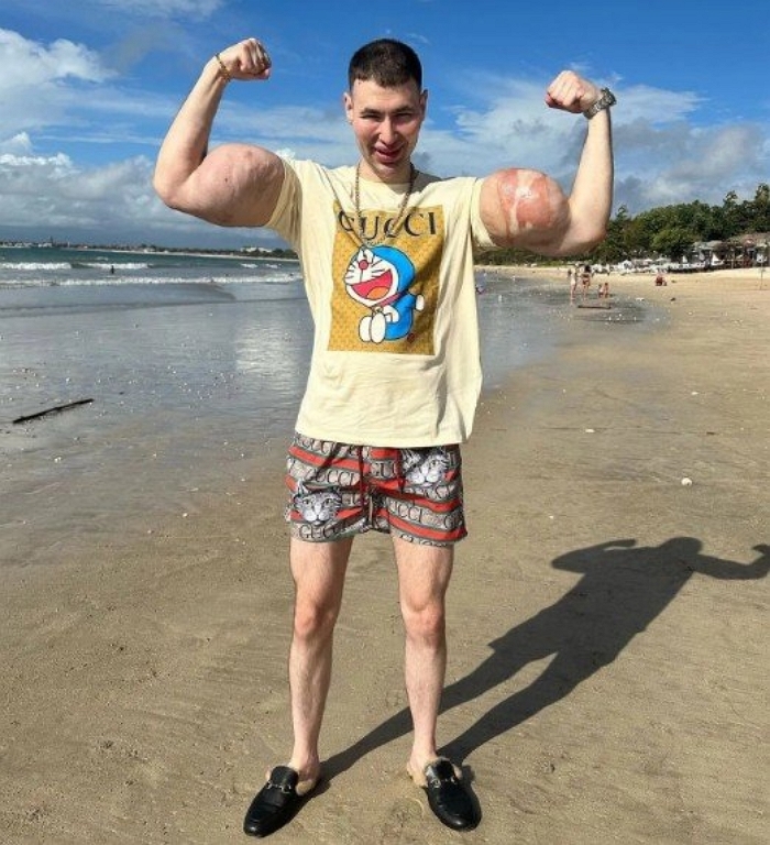 “내가 저지른 어리석음”... 석유젤 넣어 ‘뽀빠이 팔’ 만든 20대 남성, 양팔 절단 위기