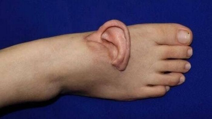 합성인 줄 알았는데... 5개월 동안 ‘발등’에 귀 달고 다닌 여성의 사연