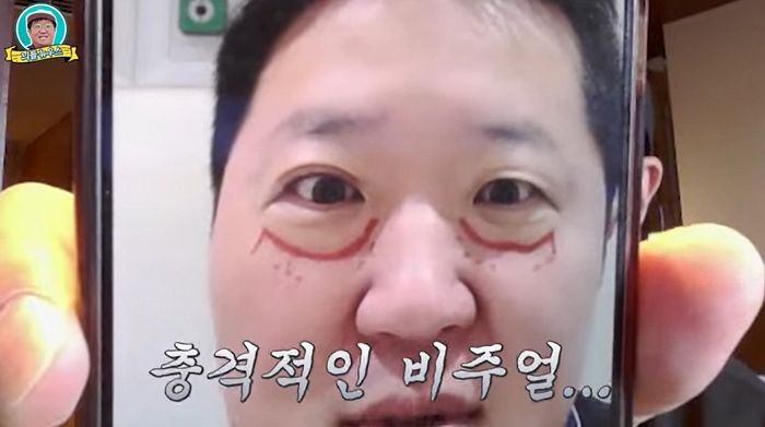 정형돈, ‘이것’ 성형 고백... 달라진 비주얼에 “누가 때렸냐”