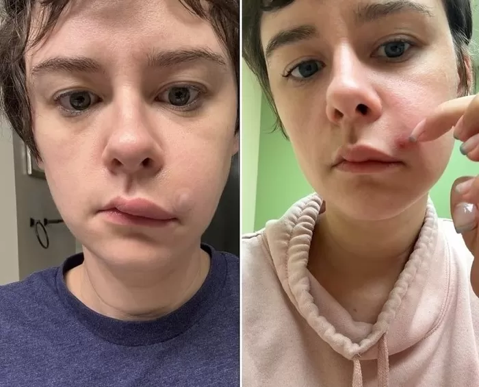 ‘죽음의 삼각형’으로 불리는 얼굴의 특정 부위에 난 여드름을 건드렸다가 심각한 감염에 걸릴 뻔한 30대 여성. 출처=데일리메일