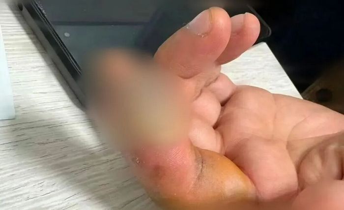 손톱 주변 거스러미 함부로 뽑았다가... “골수염으로 절단 위기”