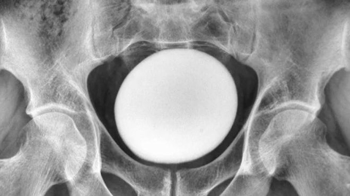 이란 35세 남성의 방광에서 발견된 타조알 크기의 결석 / 라이브사이언스 