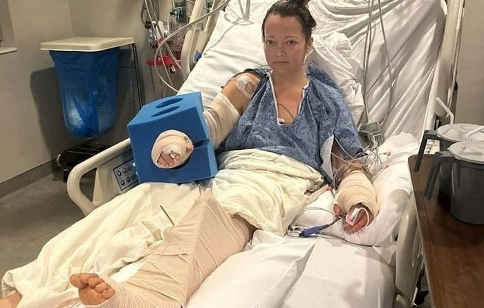 반려견 싸움 말리던 40대 여성, 자신이 키우던 핏불에 공격 당해... “한쪽 다리 잃었다”