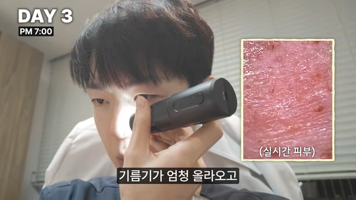 피부과 의사가 일부러 7일간 피부 망치면 생기는 일 (+충격 변화) 11-5 screenshot (1).png